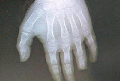 Denize girdi, parmağının yarısını kaybetti