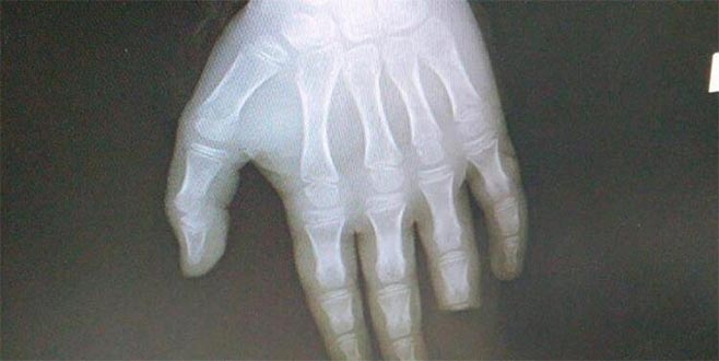 Denize girdi, parmağının yarısını kaybetti