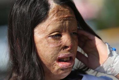 Yüzü yanan Firdevs’e vücudundan doku nakli yapıldı