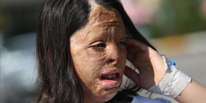 Yüzü yanan Firdevs’e vücudundan doku nakli yapıldı