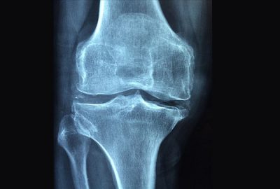 ‘Osteoporoz 3 kadından birini kıskacına alıyor’