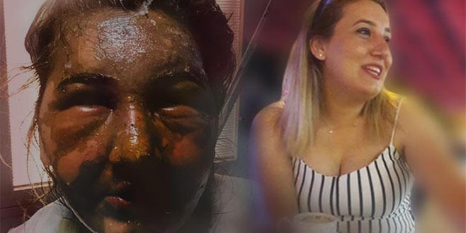 Eski karısını bu hale getirdi! ‘Önce keskin bir koku hissettim’