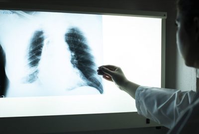 Aşırı kiloluların akciğerlerinde astıma yol açan yağ dokusu tespit edildi