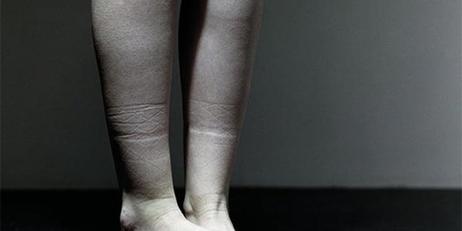 Çorap ayağınızda iz bırakıyorsa dikkat!