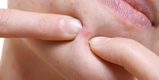 Sivilcelerden ve aknelerden kurtulma yolları nelerdir? Asla bunu yapmayın!