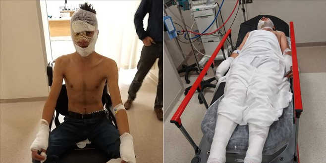 Evi kundaklamaya çalışırken bu hale geldiler