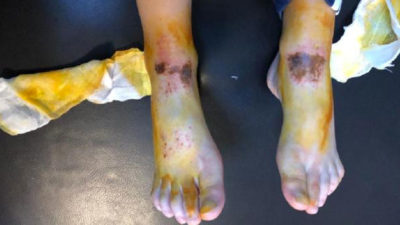 Çocuklardaki gizemli yanıkların nedeni belli oldu