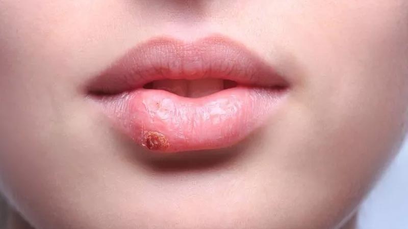 Bu problem geçene kadar öpüşmeyin!