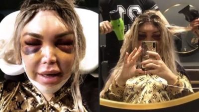 Estetik operasyon sonrası kuaför ziyareti!