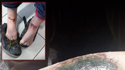 Kar yanıklarının nedeni belli oldu!