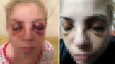 Dehşet anlarını anlattı! Diş fırçasıyla gözlerini oymaya çalışmış