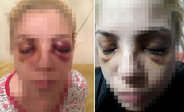 Dehşet anlarını anlattı! Diş fırçasıyla gözlerini oymaya çalışmış Dehşet anlarını anlattı! Diş fırçasıyla gözlerini oymaya çalışmış