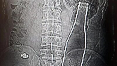 Karın ağrısıyla hastaneye gitti! Gören gözlerine inanamadı
