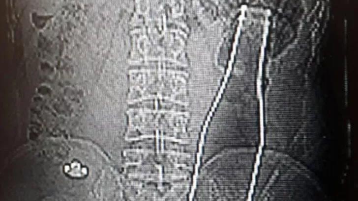 Karın ağrısıyla hastaneye gitti! Gören gözlerine inanamadı