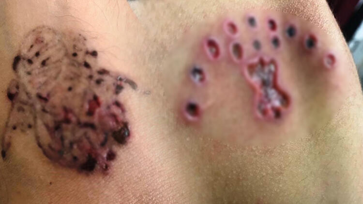 İkna oldu, hayatının şokunu yaşadı! Cildi çürüdü…