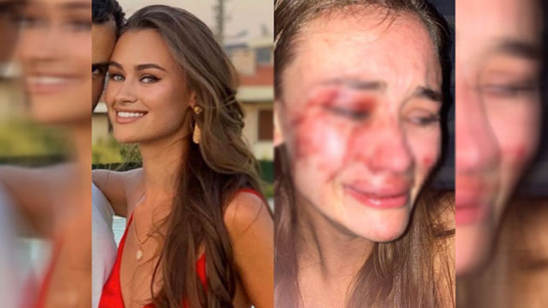 Dünyaca ünlü modele darp iddiası! Açıklama geldi…