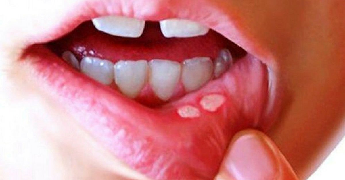 Aft yaralarını 1 saat içerisinde geçiriyor! İşte mucizevi yöntem Aft yaralarını 1 saat içerisinde geçiriyor! İşte mucizevi yöntem