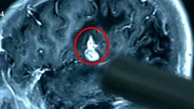 17 yıldır kafasında olan kurtçuk beynini yemeye başladı!