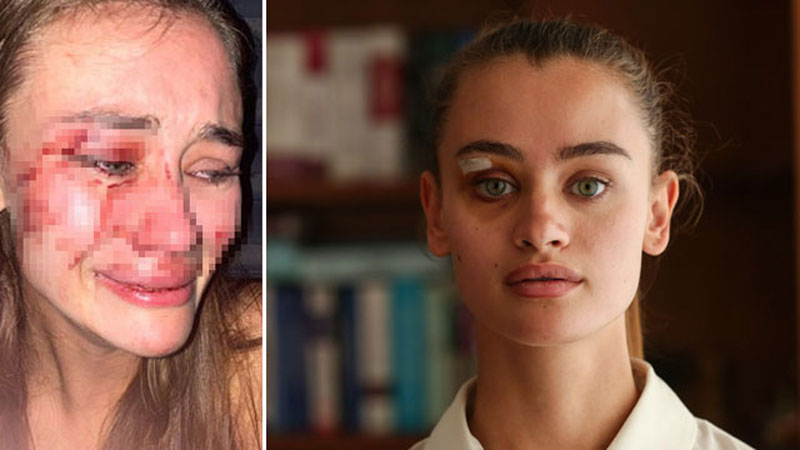 Dayak yediğini söylemişti! Ünlü model koronavirüse yakalanmış