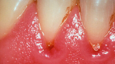 Unutkanlık sıkıntısı çekenler dikkat! Diş etinde o şey…