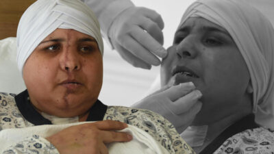 Bursa’ya dönüş yolunda yüzü ikiye ayrıldı! 10 saatlik ameliyatla birleştirildi