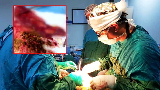 Ameliyatta fark ettiler! Karnından çıkanlar doktorları bile şaşırttı Ameliyatta fark ettiler! Karnından çıkanlar doktorları bile şaşırttı