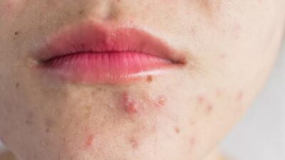 Ölümcül üçgene dikkat! Bu bölgedeki sivilceyi sıkmayın