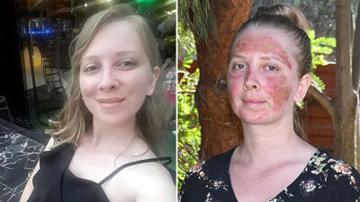 Güzellik merkezinde cilt bakımı yaptırdı… Yüzünü o halde görünce…