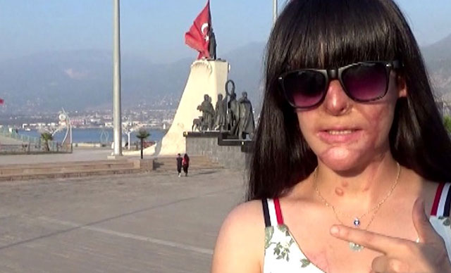 Yüzüne asit atan saldırganı affeden Berfin: Bu karardan çok pişmanlık duydum