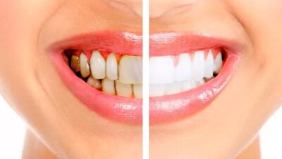 Sizi dişçiye gitmeden kurtaracak!