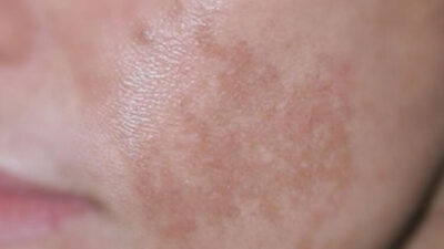 ‘Ağır makyaj’ tehlike saçıyor! Akne, egzama gibi şikayetler artacak…