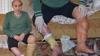 Ayak ülseri hayatını kararttı! Evden dışarı çıkamıyor