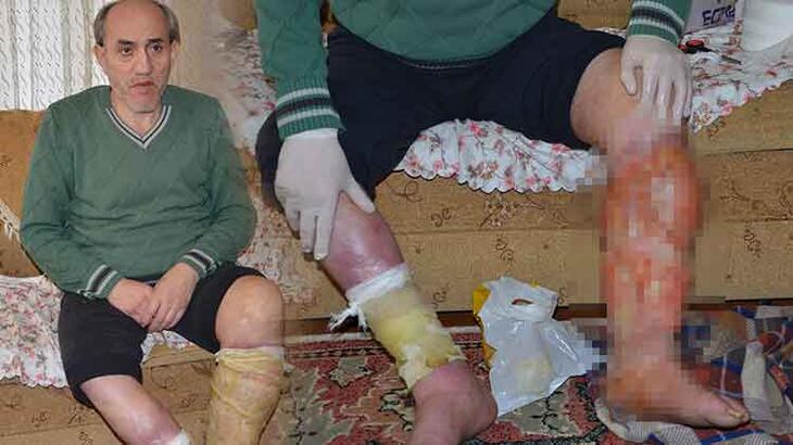 Ayak ülseri hayatını kararttı! Evden dışarı çıkamıyor