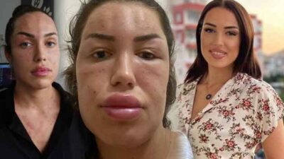 Gençlik aşısı yaptıran kadın tanınmaz halde! Vücudu nodülle kaplandı