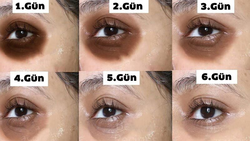 Çoğunlukla esmer teni ve kuru cildi olan insanların göz altında