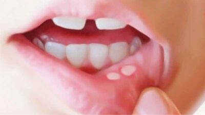 Ağızdaki yaraları 1 saat içinde yok ediyor…