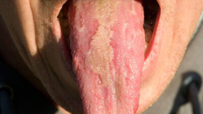 Vücuttaki o vitamine dikkat!