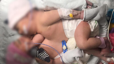 8 gün sonra Cerrahpaşa’dan gelen müthiş haber! Siyam ikizleri ayrıldı