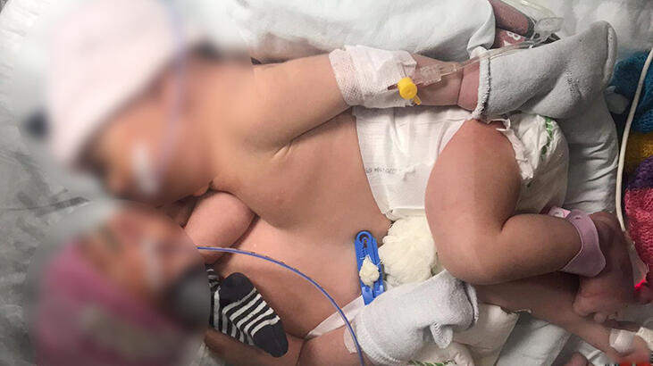 8 gün sonra Cerrahpaşa’dan gelen müthiş haber! Siyam ikizleri ayrıldı