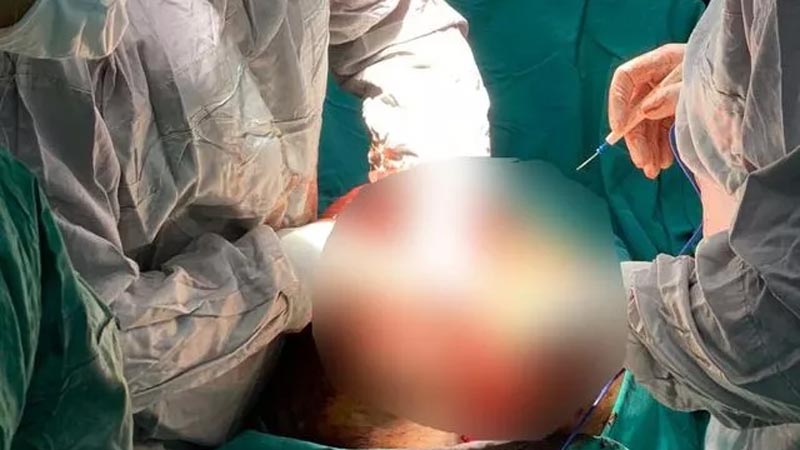 Şoke eden görüntü! Hastanın karnından 14 kilo tümör çıktı Şoke eden görüntü! Hastanın karnından 14 kilo tümör çıktı
