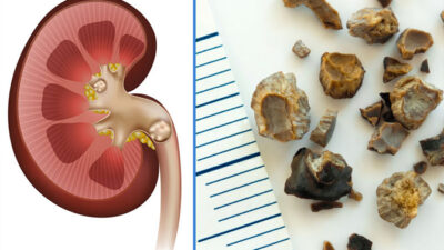 Böbrek taşının ilacı onda saklı!