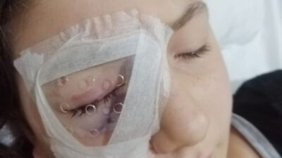 Yastık savaşında feci son! Gözü parçalandı