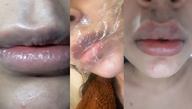 Dudağını kaybedebilir! Yarım saat sonra beni odaya çağırdılar…