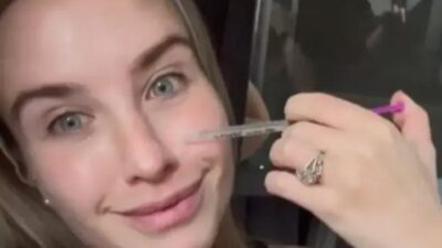 Yaşlanmayı önlemek için yüzüne anne sütü enjekte ediyor