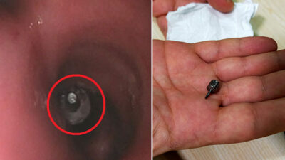 Bursa’da akıl almaz olay! Akciğerine implant parçası kaçtı