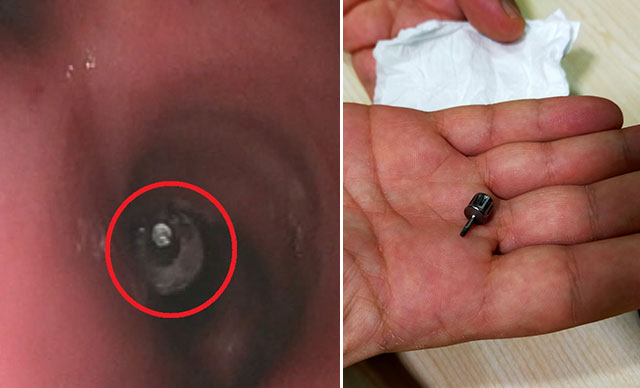 Bursa’da akıl almaz olay! Akciğerine implant parçası kaçtı