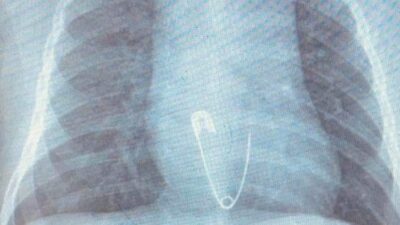 5 aylık bebeğin yuttuğu çengelli iğne soluk borusuna saplandı!