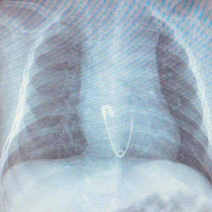 5 aylık bebeğin yuttuğu çengelli iğne soluk borusuna saplandı!