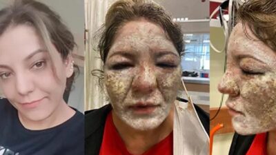 ‘Cildi bebek gibi olacak’ dediler! Kabusu yaşadı