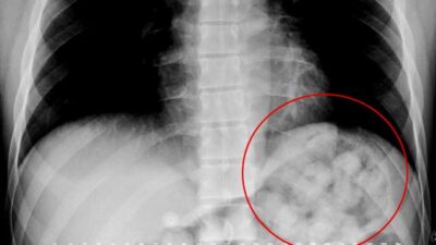 Midesinden 900 gram uyuşturucu madde çıktı